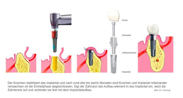 Implantat Ablauf - Bad Tölz