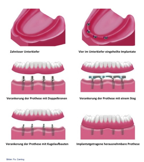 Zahnlosichkeit - Implantat